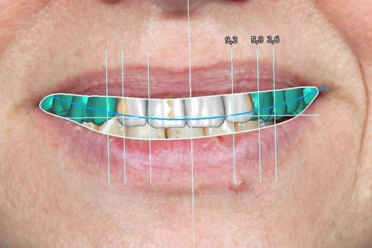 Clínica Blay+Monzó, especialistas en el diseño de sonrisas