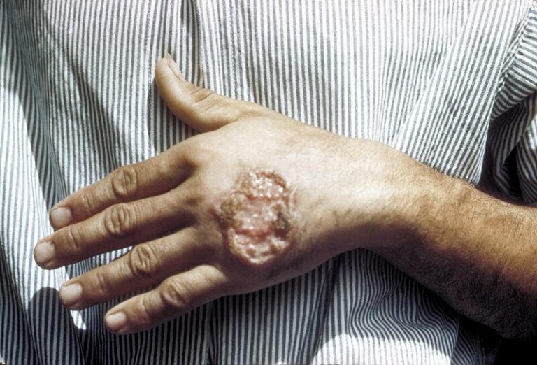 En España registra mayor incidencia de sarna, mientras la de leishmaniasis se mantiene