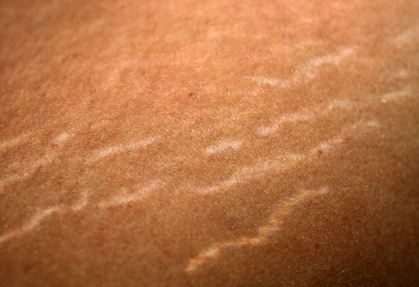 ¿Qué debo hacer para tratar las estrías?