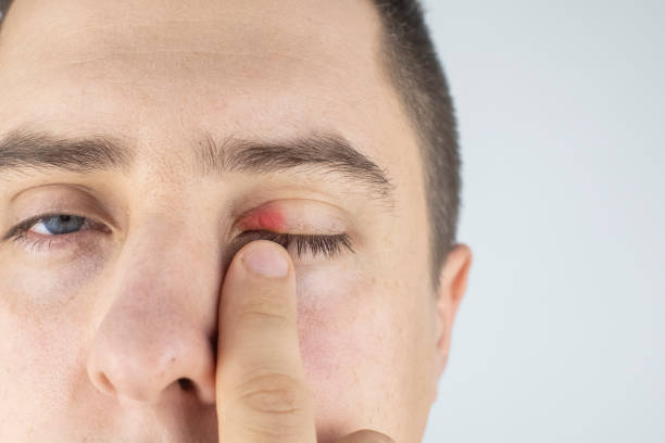 Remedios caseros para eliminar un orzuelo 4 Tome precaución