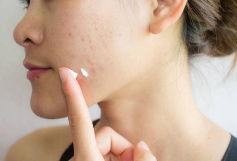 El motivo por el que echarte pasta de dientes en las espinillas es muy peligroso