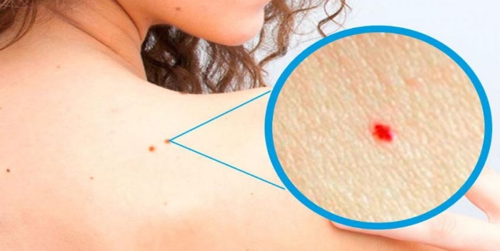 Puntos rojos en la piel, ¿son peligrosos?