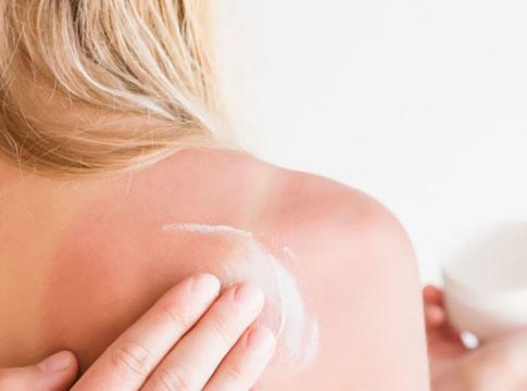 Qué es bueno aplicarse para las quemaduras 1 Qué es bueno aplicarse para las quemaduras