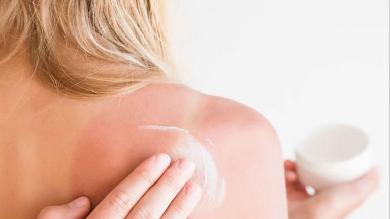 Qué es bueno aplicarse para las quemaduras