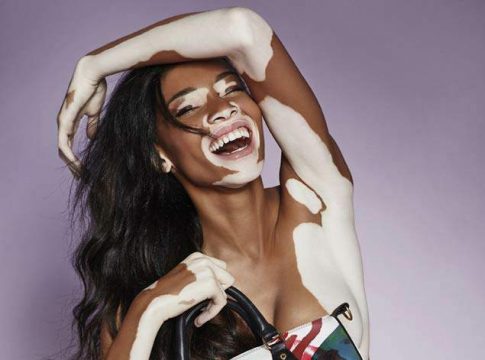 Qué es el vitíligo 1 Qué es el vitíligo