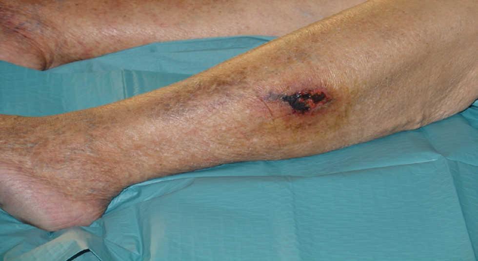 ¿Qué es la calcifilaxia?