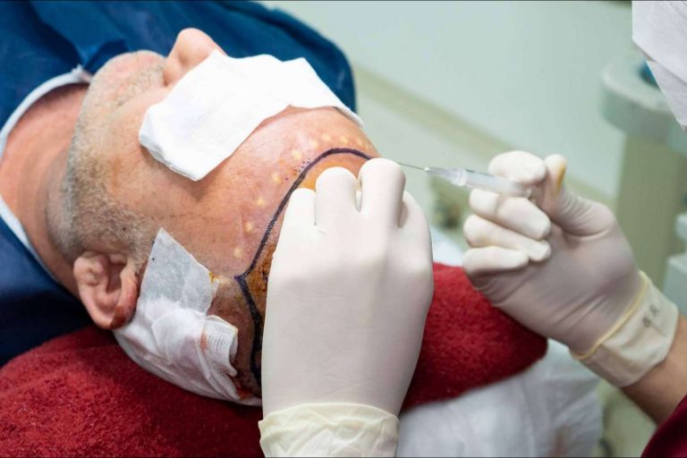 La técnica FUE para realizar injertos capilares de calidad de la mano de Neocapilar