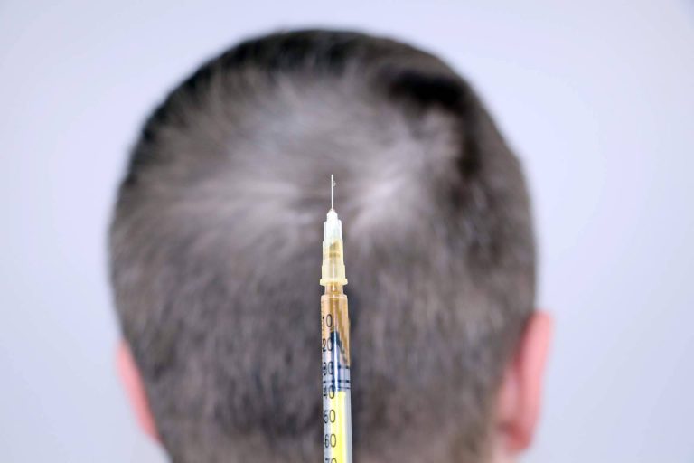 La mesoterapia capilar es un tratamiento que realiza el Dr. Bruno Jacobovski para el cuidado profundo del cuero cabelludo ante la caída del cabello