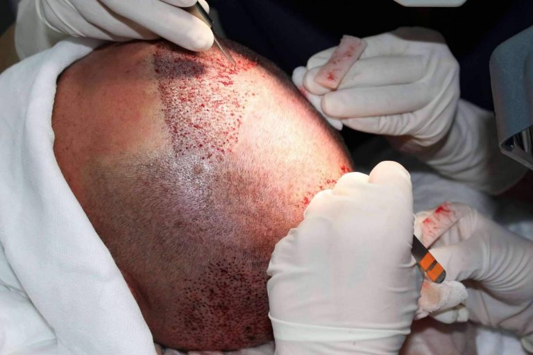 Recuperar el cabello con Injerto Capilar en Murcia y sus técnicas