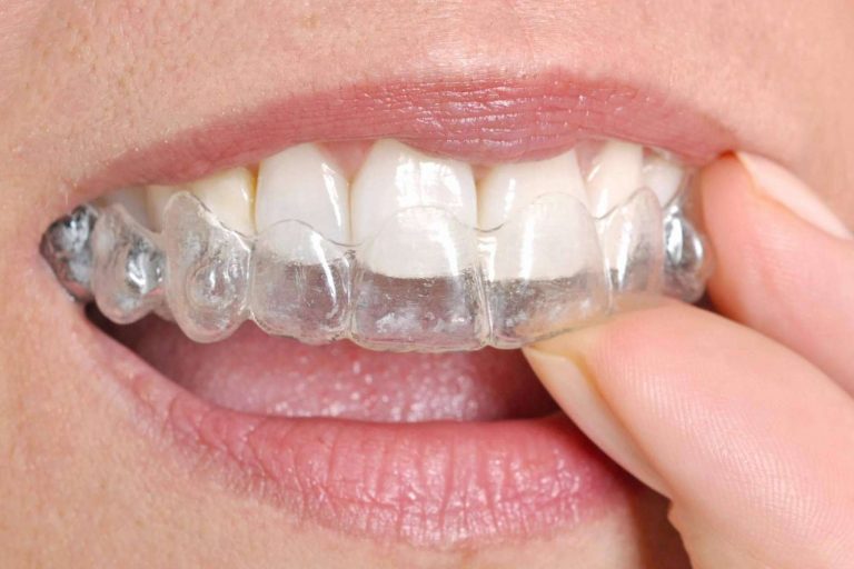 Los centros recomendados con el Certificado de Calidad DentalQuality® cuentan con servicios de ortodoncia invisible