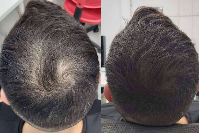 Los tratamientos de micropigmentación con efecto de redensificación que realizan las Clínicas Dr. Pelo