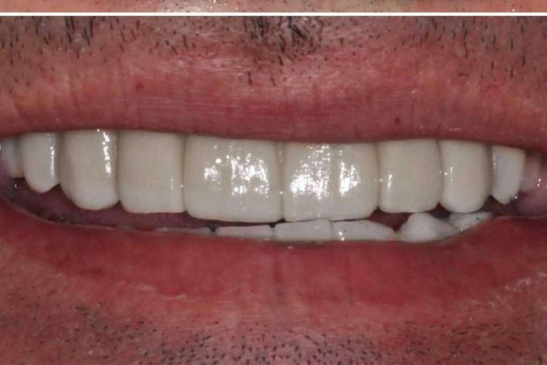 Implant Clinics resalta los beneficios de su tratamiento ALL ON 4