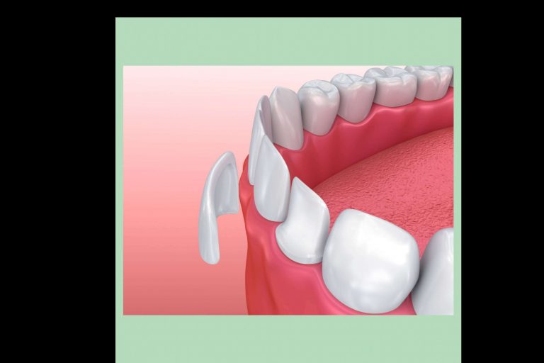 Clínica Paula Vidal, carillas dentales de calidad