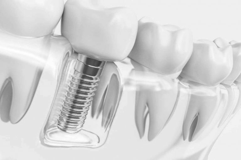 Grupo Gente Vital asegura la calidad de sus tratamientos de ortodoncia invisible