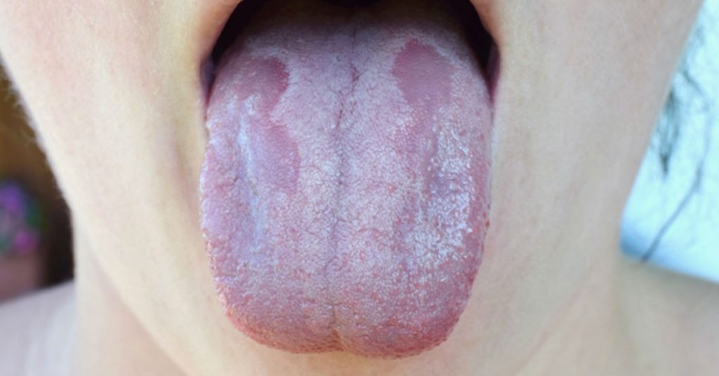 Este es el motivo por el que se te pone la lengua blanca