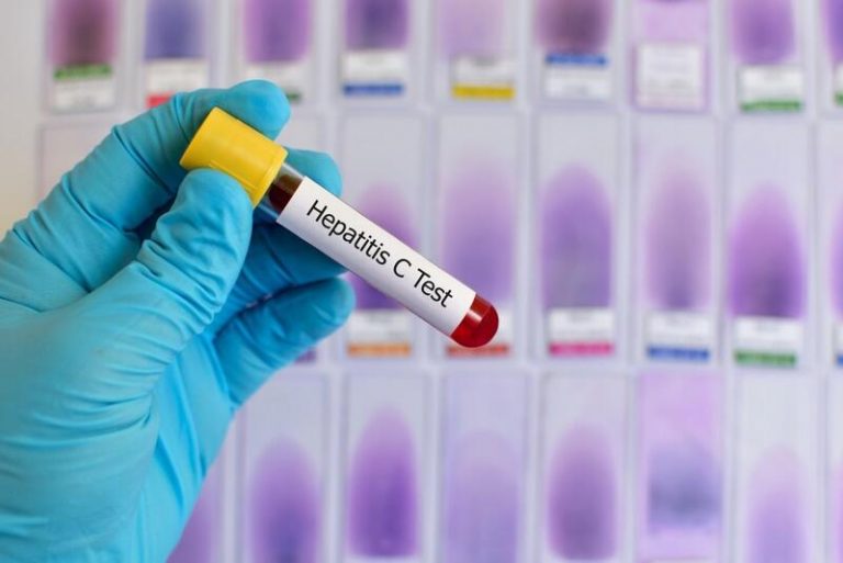 1 de cada 4 pacientes con hepatitis viral crónica B o C se diagnostica de forma tardía