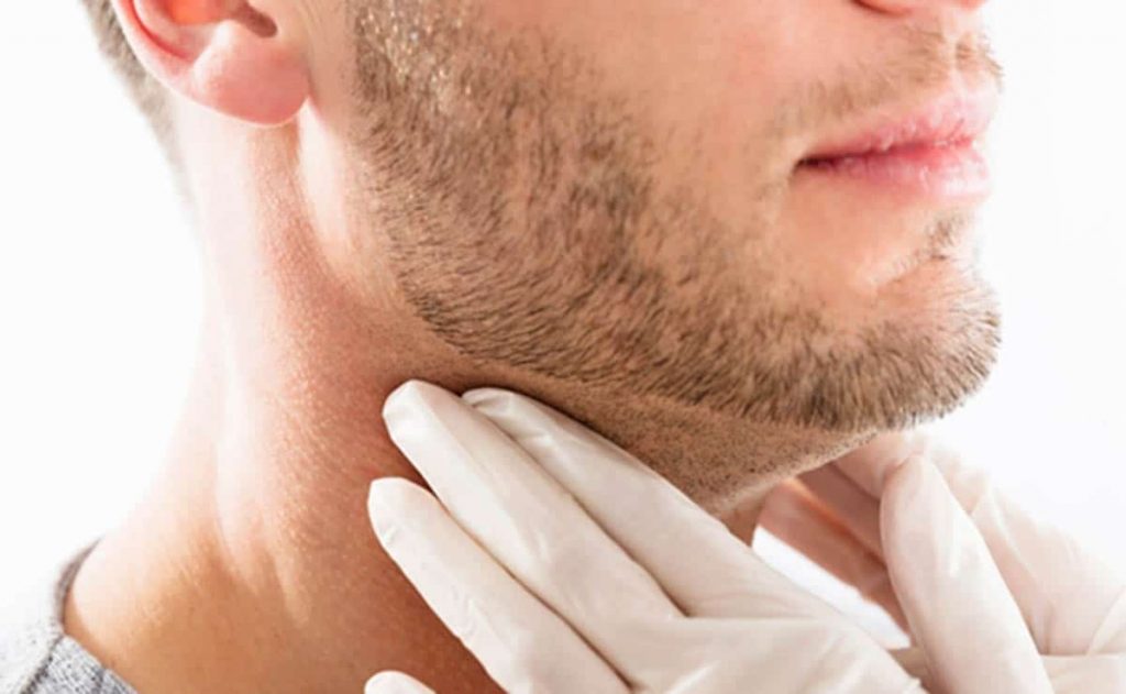 Enrojecimiento facial y síndrome carcinoide: ¿Pueden los tumores afectar tu piel?