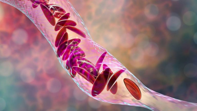 Síntomas que te avisan de que tienes anemia