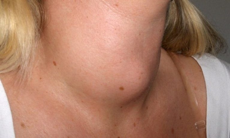 Tengo un bulto en el cuello: ¿qué puede ser?