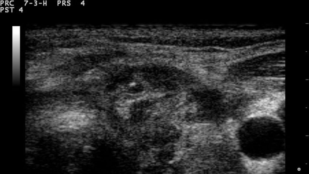 ¿Sabías que la torticolis puede causar un bulto en el cuello?