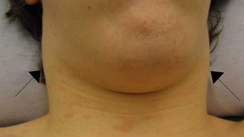 ¿Cuáles son los síntomas que acompañan generalmente a la presencia de un bulto en el cuello? 
