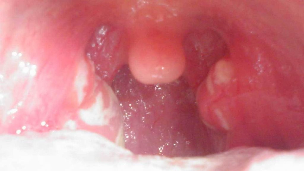¿Cuáles son las otras razones de originarse un bulto en el cuello?