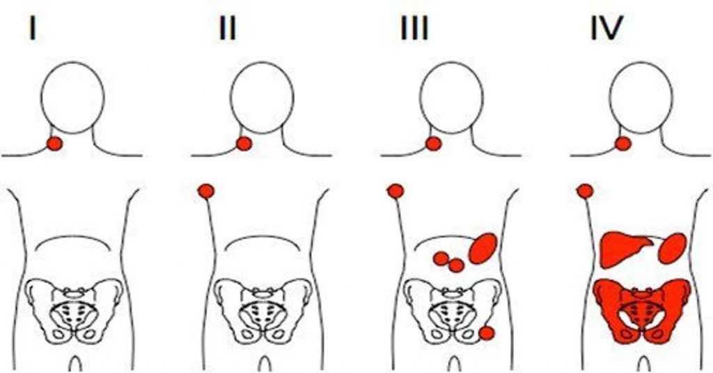 Un quiste puede causar un bulto en el cuello