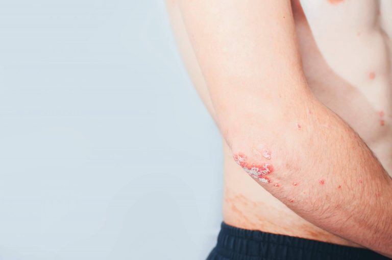 Tratamiento efectivo para la psoriasis con los productos de Soriasel