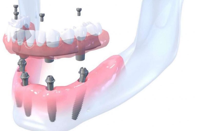 Rehabilitaciones orales complejas en un día en la clínica dental Bordonclinic