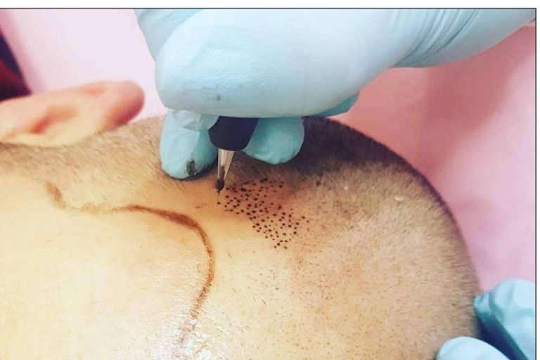 Los profesionales de la micropigmentación pueden ampliar sus conocimientos y aprender técnicas de micropigmentación capilar de la mano del centro VG Virginia Gómez