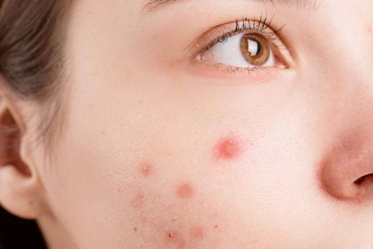 Bėyo Beauty dispone de un tratamiento contra el acné que brinda muchos beneficios