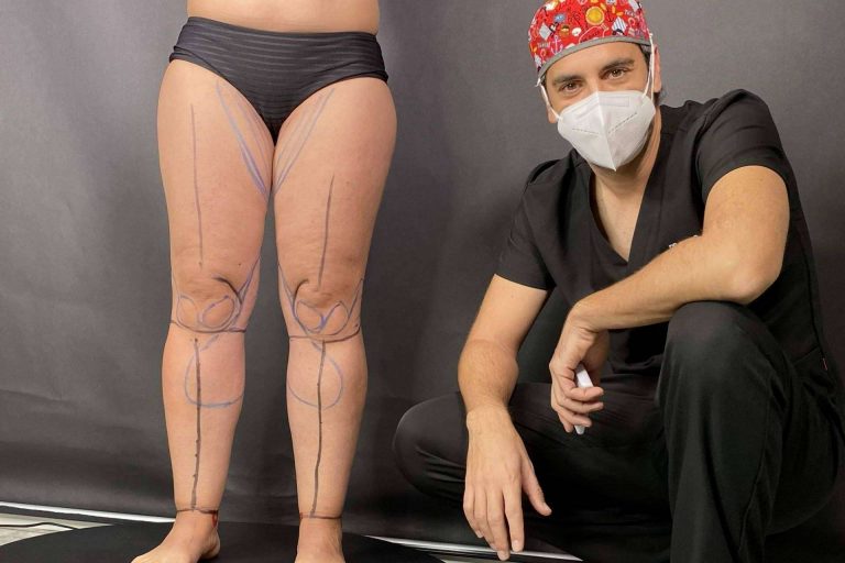 Se crea el Instituto Valenciano de Lipedema, IVALI