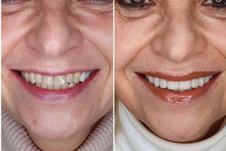 Conseguir una adecuada estética dental en 2 visitas, con Dentinova