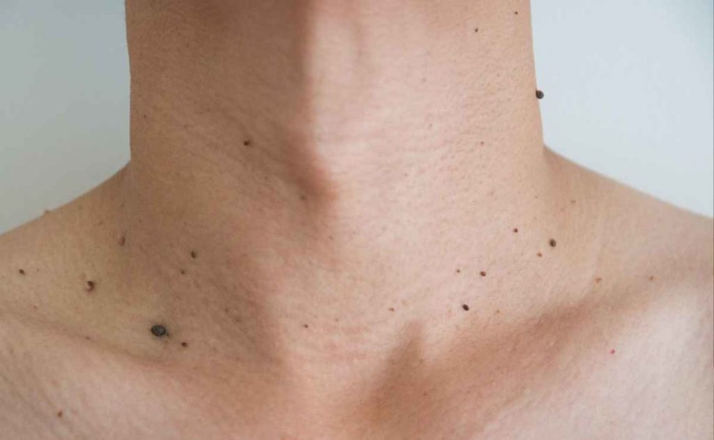 ¿Qué otras opciones de tratamiento hay?