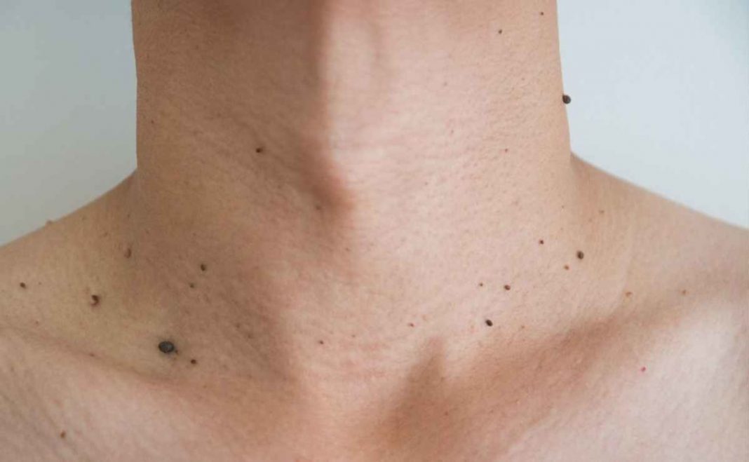 Esto es lo que pasa si te quitas una verruga