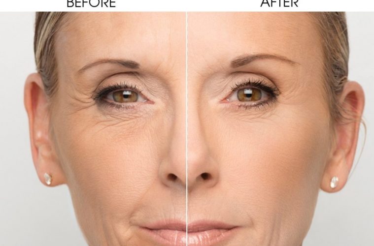 Hialuronato de sodio