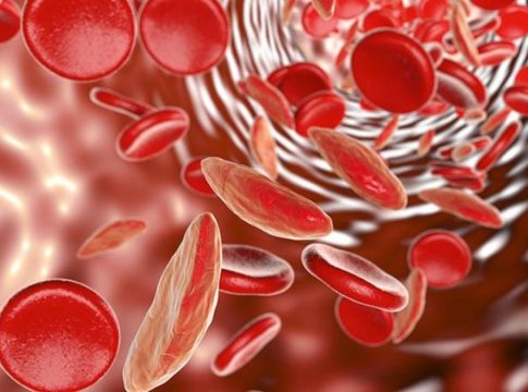 Que es la anemia megaloblástica 1 Que es la anemia megaloblástica