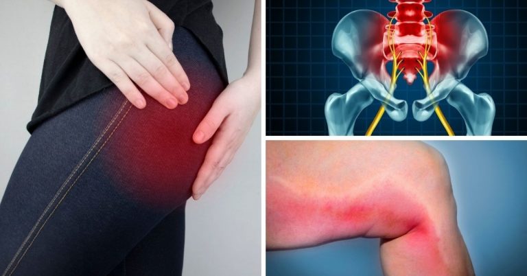 Qué es la falsa ciática
