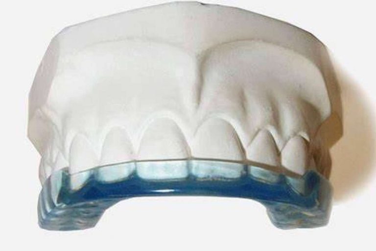 El bruxismo, ¿qué es y cómo se puede solucionar?, por Implant Clinics