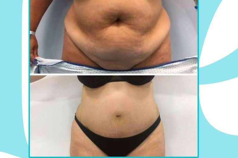 Lucir un cuerpo de ensueño gracias a la cirugía estética corporal de Clínicas Be