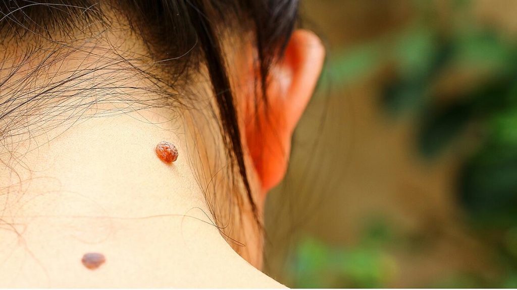 Esto es lo que pasa si te quitas un lunar 190 Puedes complicarte la vida con el lunar
