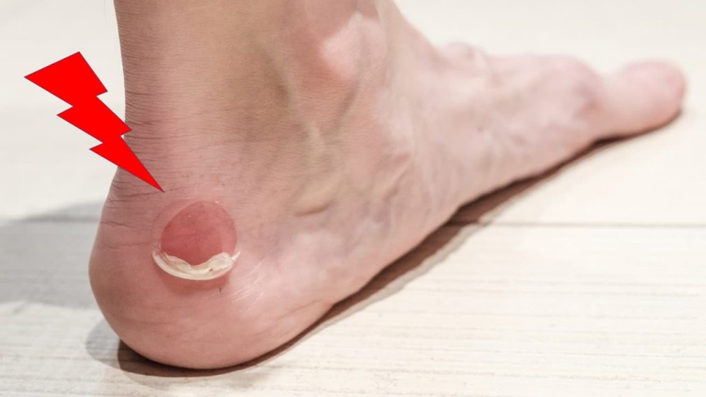 ¿Hay Ampollas que se originan por el calzado?