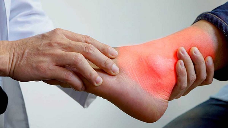 Cómo saber si tienes el ácido úrico alto sin ir al médico