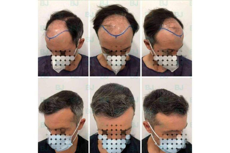 ¿Cuáles son las diferencias de las técnicas de implante capilar FUE y FUSS en la clínica capilar de Dr. Bruno Jacobovski?