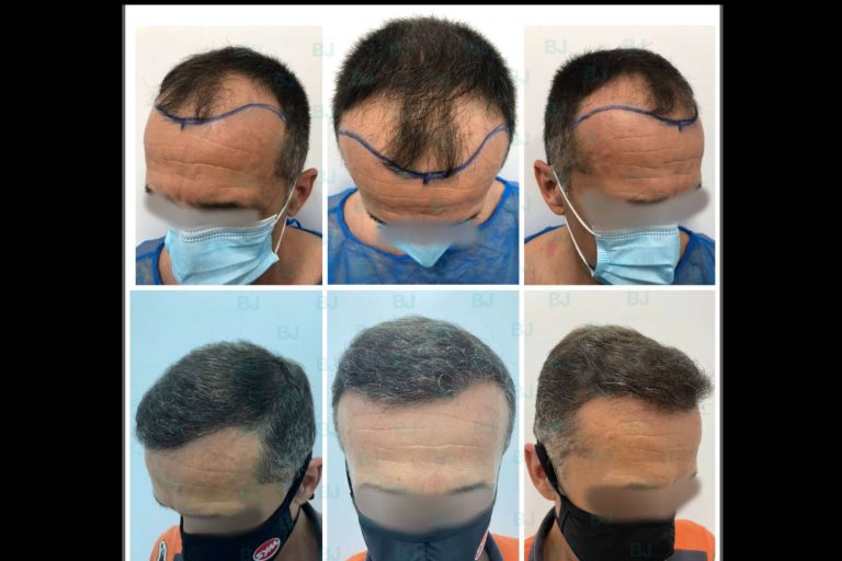 El Dr. Jacobovski asesora acerca el injerto capilar