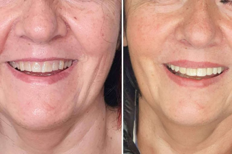 Conseguir una sonrisa Hollywood gracias a los servicios de Dentinova