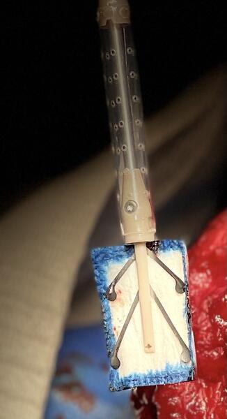 Cirujanos utilizan por primera vez en España un implante bioinductivo para reparar el tendón del tríceps