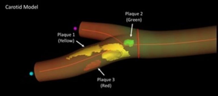 La ecografía vascular en 3D matrix identifica con precisión el daño cardiovascular en personas sanas