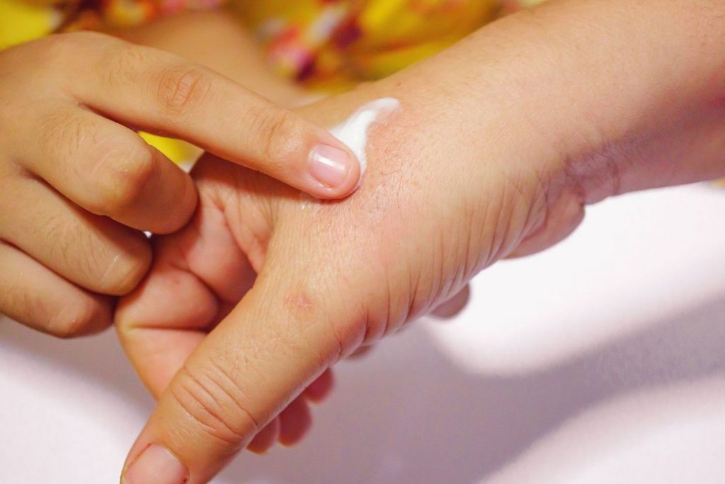 Esto es lo que debes hacer si te quemas con agua hirviendo 10