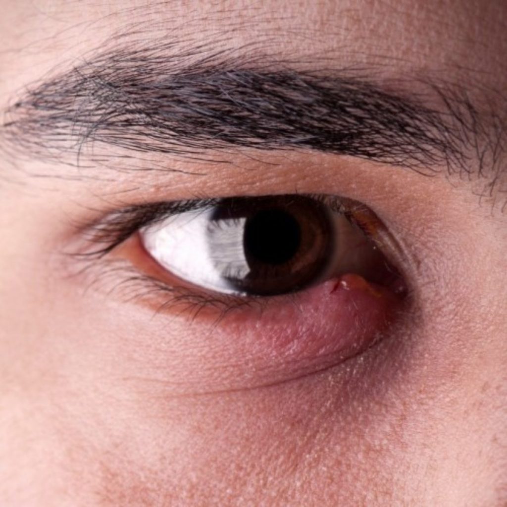 Orzuelos: por qué salen y cómo eliminarlos en 48 horas 80 ¿Qué hacer si persisten los orzuelos?